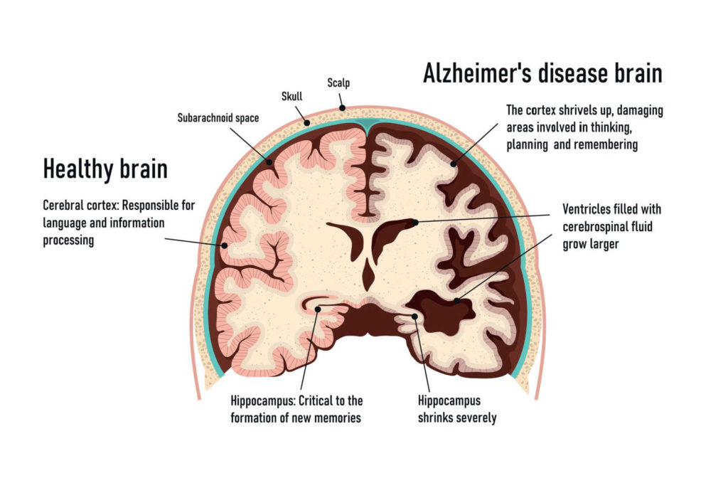 graphical cross section of a brain showing a healthy brain compared to a brain with Alzheimer's.