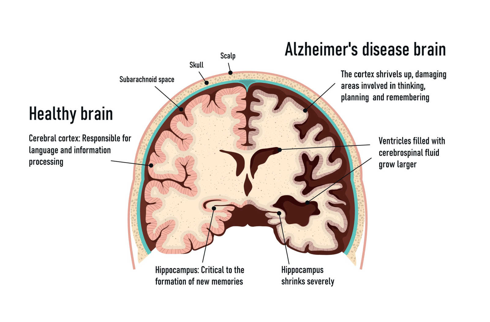 does-early-onset-alzheimer-s-progress-faster-saranac-lake